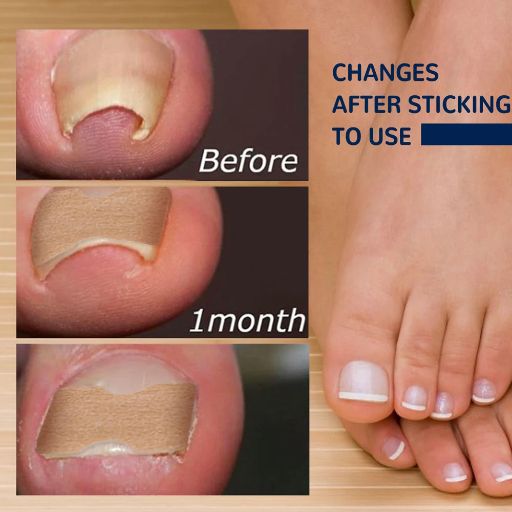 Designed for use on both fingernails and toenails for versatile correction and care.