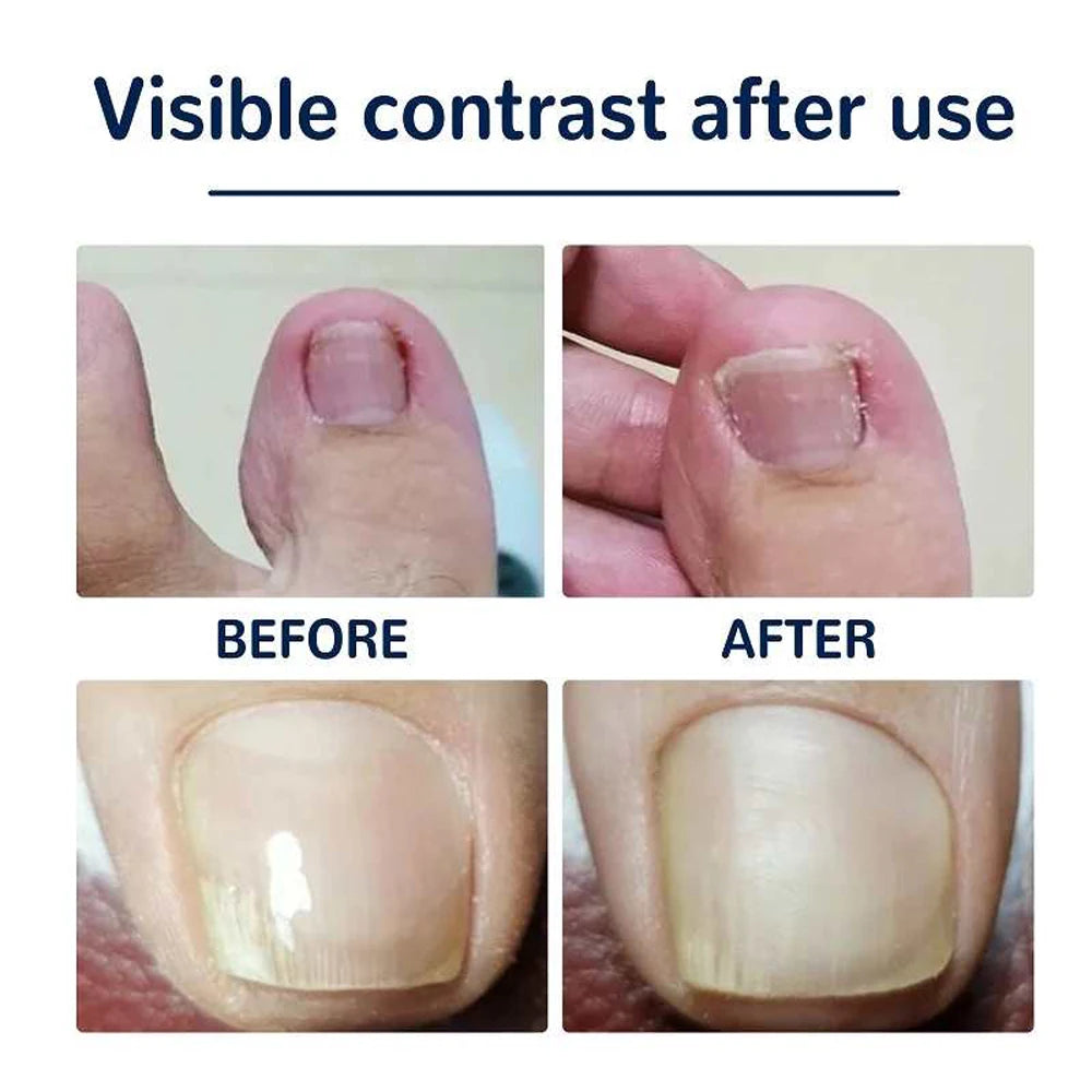 Designed for use on both fingernails and toenails for versatile correction and care.